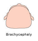 plagiocephaly brachysephaly how to prevent flat head syndrome