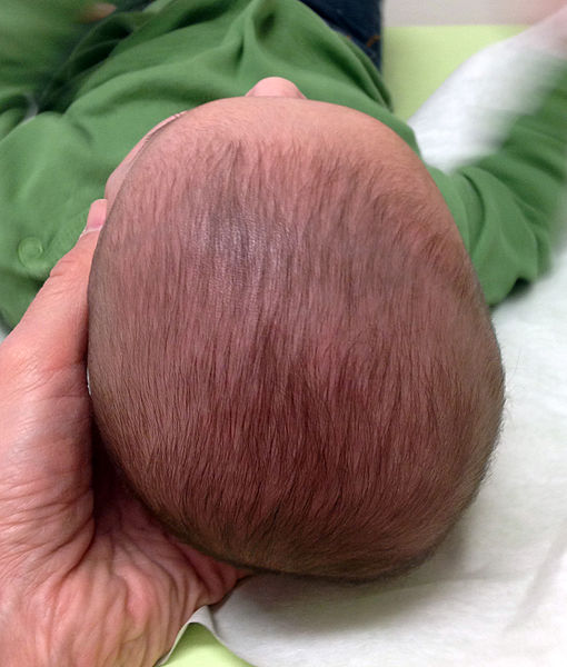 plagiocephaly | how to prevent flat head syndrome