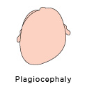 plagiocephaly how to prevent flat head syndrome